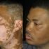 vitiligo-orbita2-9-fm-e1446777021431